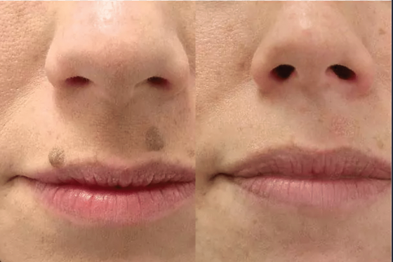 Chirurgie des grains de beauté